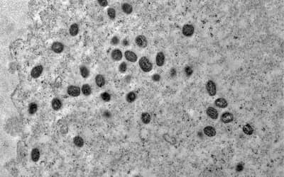 Mpox: São Paulo confirma segundo caso da doença pela nova cepa clado Ib